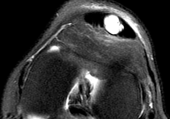 Figure 4 for case Intratenindous ganglion